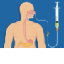 Nasogastric Feeding Tube