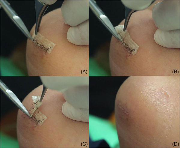 Stitches Removal